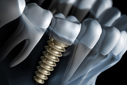 Dental Implants in Hinjewadi
