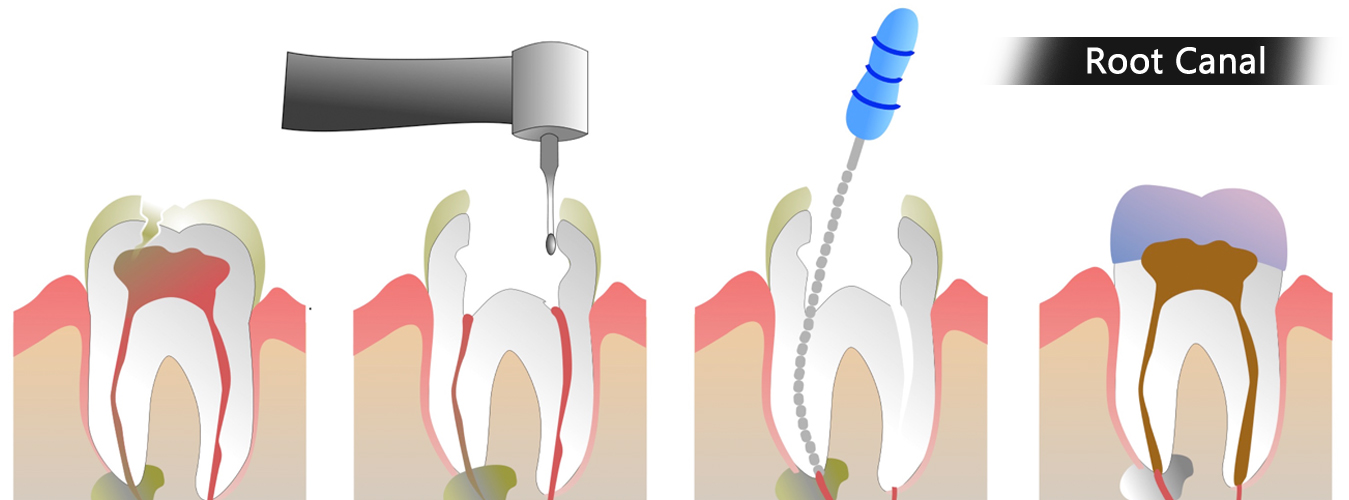 Root Canal Treatment In Pune