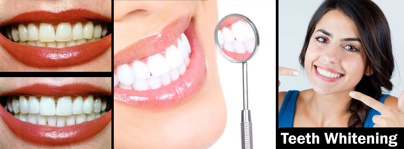 Best Teeth Whitening Treatment in Pune