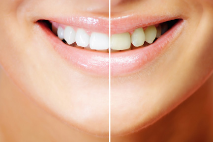 Best Teeth Whitening Treatment in Hinjewadi