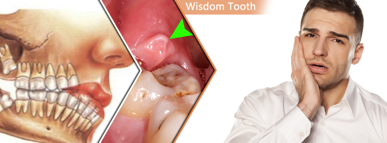 Best Wisdom Tooth Treatment in Pune