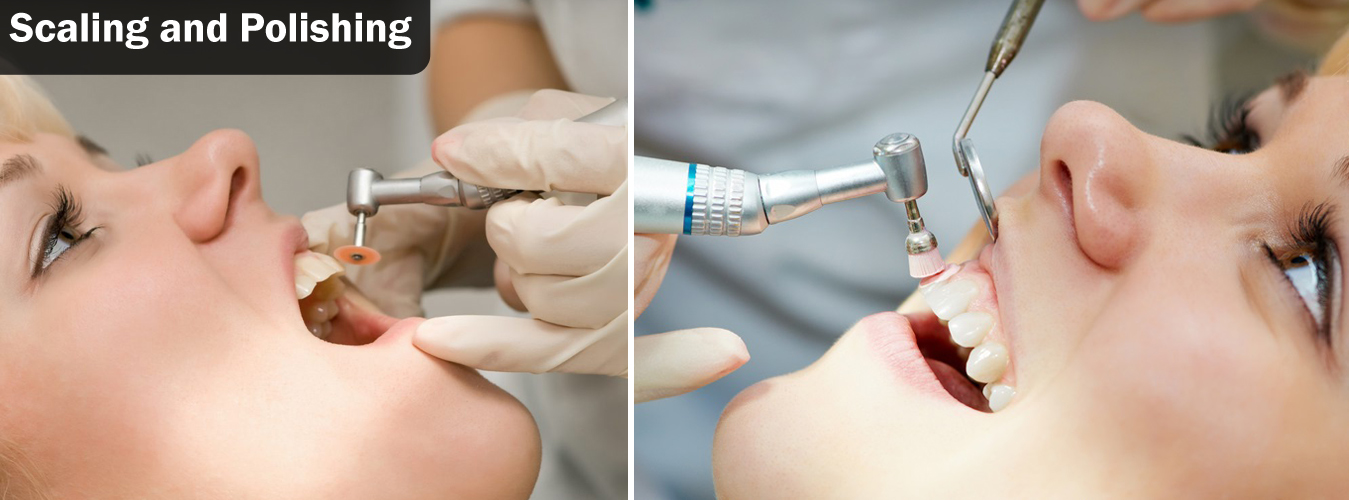 Scaling And Polishing Treatments in Pune